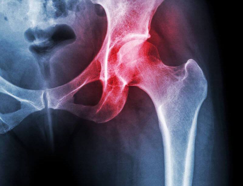 epivyziva-lexikon-nemoci-osteoporoza